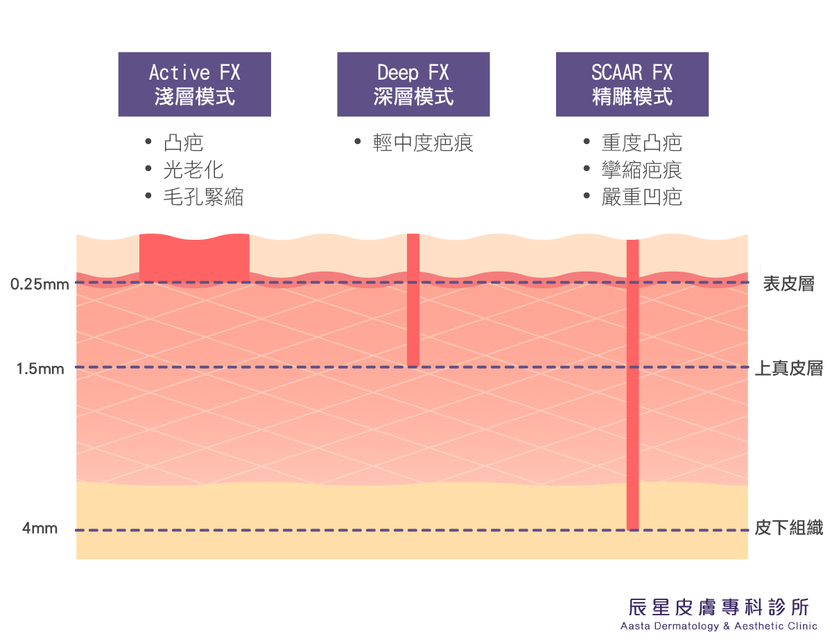 UP雷射有三種模式:淺層膜式、深層模式與精雕模式,能夠根據局部嚴重程度的不同搭配治療,優質化膚質,改變原本凹凸不平、粗糙的肌膚表面。