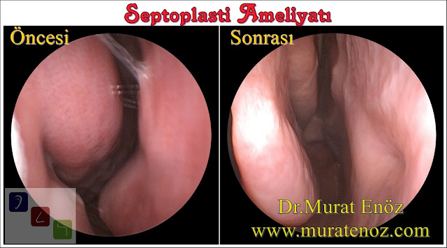 Septoplasty Operation Before and After