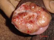 Obat Infeksi Menular Seksual Obat Infeksi Menular Seksual