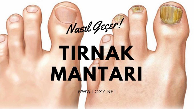 tırnak mantarı nasıl geçer tırnak mantarı nasıl geçer