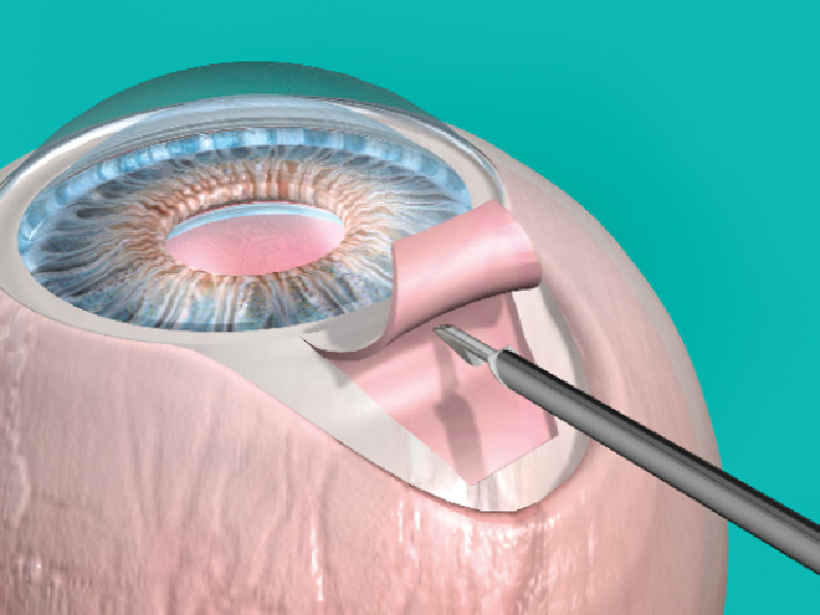 Surgery Procedure Trabeculectomy and Sclerectomy Eye