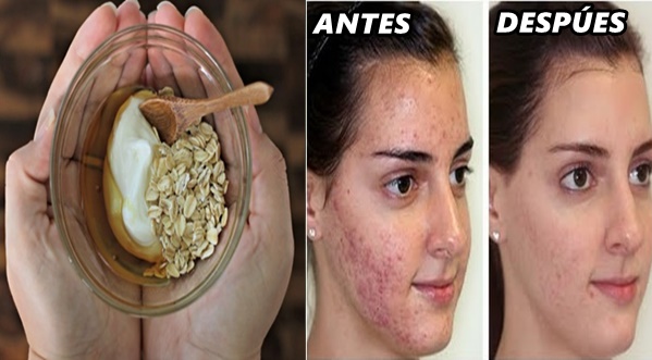 Mascarilla de perejil para el acne
