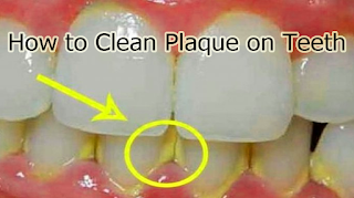 How to Clean Plaque on Teeth