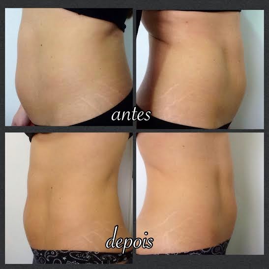 Radiofrequencia Antes E Depois Na Barriga