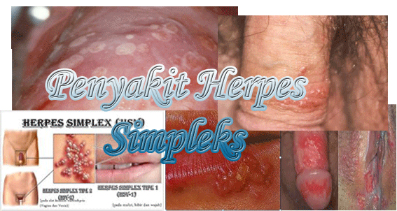 Penyakit herpes Simpleks