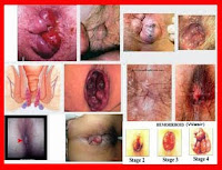 Obat Wasir Atau Ambeien Untuk Ibu Hamil Dan Menyusui Yang Aman Obat Wasir Atau Ambeien Untuk Ibu Hamil Dan Menyusui Yang Aman