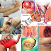 Ambeien (Hemorrhoid) Makin Banyak Penderitanya thumbnail
