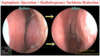 Septoplasty Operation + Radiofrequency Turbinate Reduction