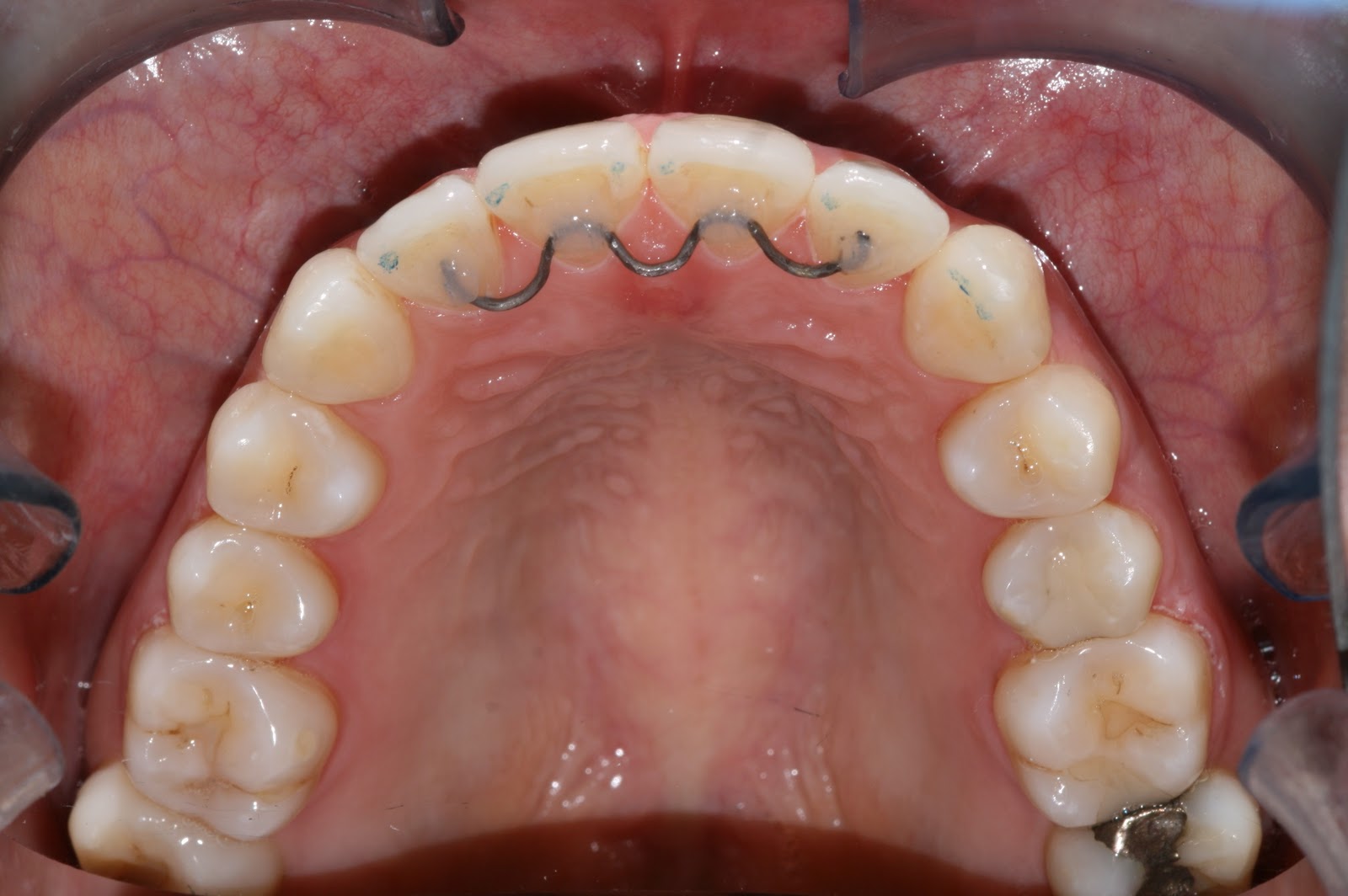 Sessions Ortho Blog Orthodontic Bonded Retainer for the