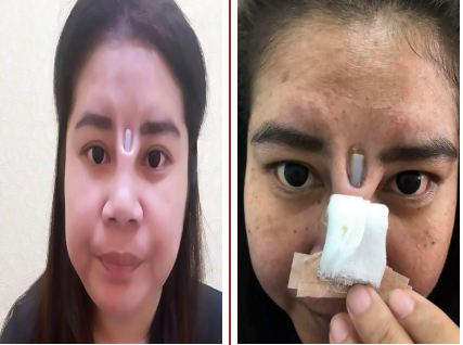 Your Daily Vendor Nose Job Gone Wrong Leaves Lady With Implant Poking Through Her Skin