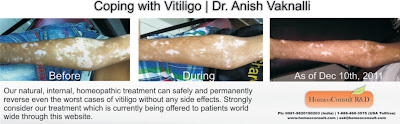 homeopathic medicines vitiligo