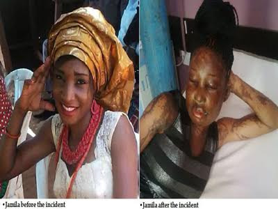 abuja acid attack victim 