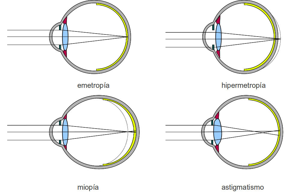 OPTICA/OPTOMETRÍA AMETROPIAS