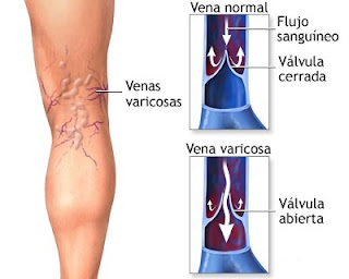 como-curar-las-varices