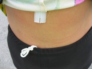 How To Lose Stretch Marks Fast, Naturally And After Pregnancy: How To