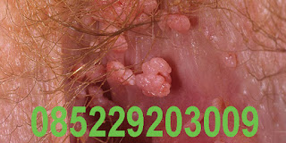 obat kutil kelamin Obat kutil kemaluan kelamin tanpa operasi tanpa efek samping, mujarab, manjur, ampuh, meghilangkan, penghapus, penghilang, kutil kelamin pria, laki-laki, wanita, perempuan, Ibu hamil mengandung menyusui, penis vagina dalam luar, anus dubur, paha aman dan terbukti, BARANG DIJAMIN SAMPAI, 100% BERGARANSI. KESEMBUHAN DAN KEPUASAN KONSUMEN ADALAH PRIORITAS KAMI. Obat Kutil - untuk menyembuhkan kutil di kulit kemaluan kelamin yang aman & ampuh terbuktinya dapat menghilangkan kutil kelamin, obat kutil buat pada untuk pria laki-laki wanita perempuan Ibu hamil mengandung menyusui, obat kutil dikemaluan kelamin genital. 0852-2920-3009 BBM: D80F52F5