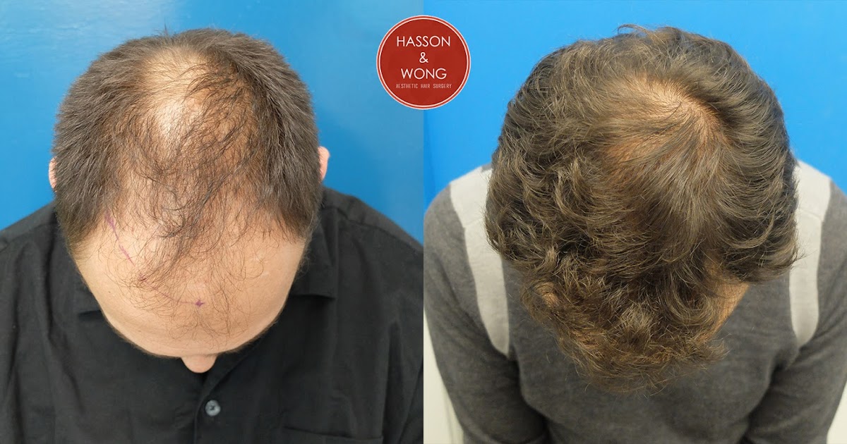 hair solutions Hasson & Wong Clinic Sessions 1 Grafts Implanted