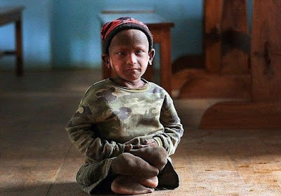 مرض نادر، تمثال حجري، عجائب وغرائب