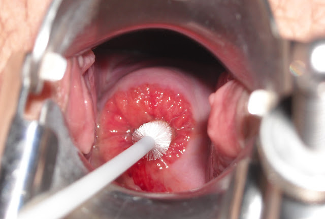 Symptoms Of Cancer Of Cervix That Should Be Known Symptoms Of Cancer Of Cervix That Should Be Known