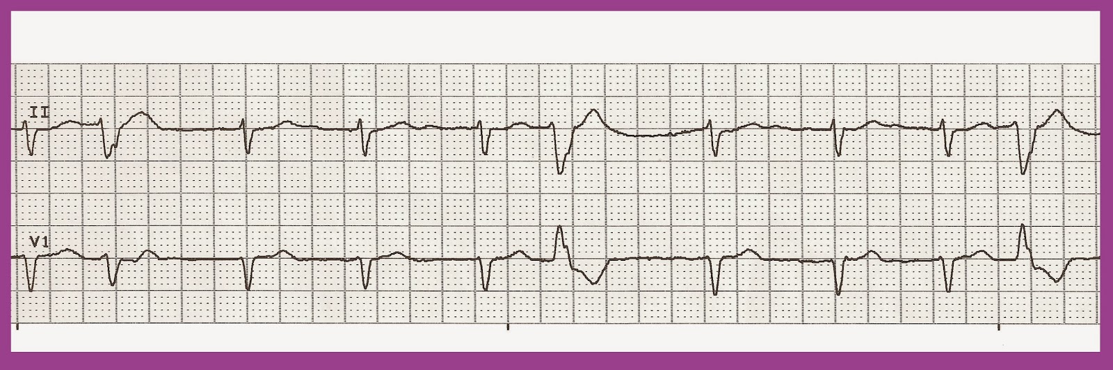 Quadrigeminal Pvc