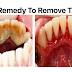 Save Yourself From Expensive Dental Treatments; A Home Remedy To Remove TARTAR