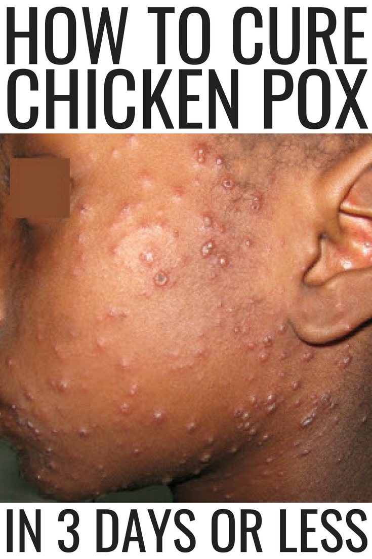 How To Cure Chicken Pox In 3 Days Or Less