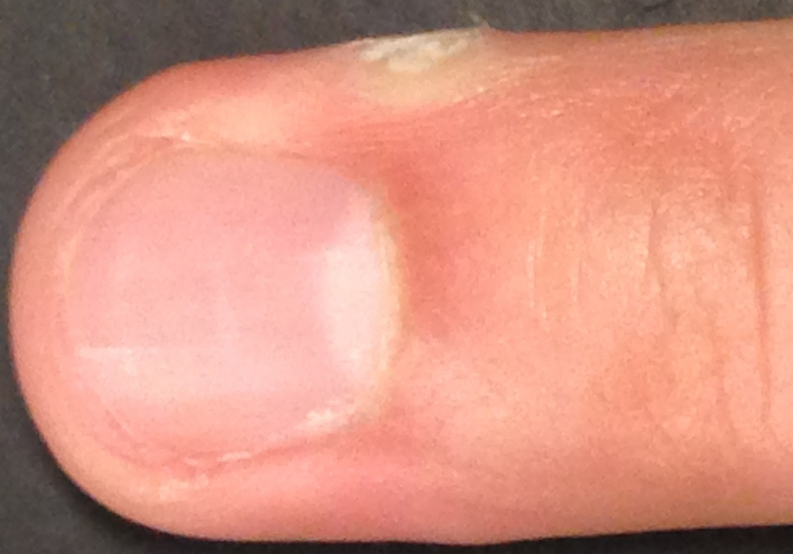 Compound W FastActing GEL Photo Review Fourth Treatment