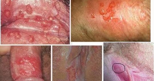 Obat herpes untuk bayi