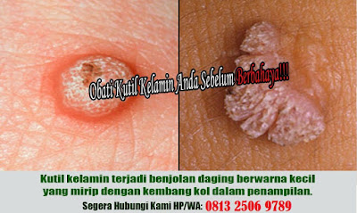 Foto obat herbal penyakit kutil kelamin