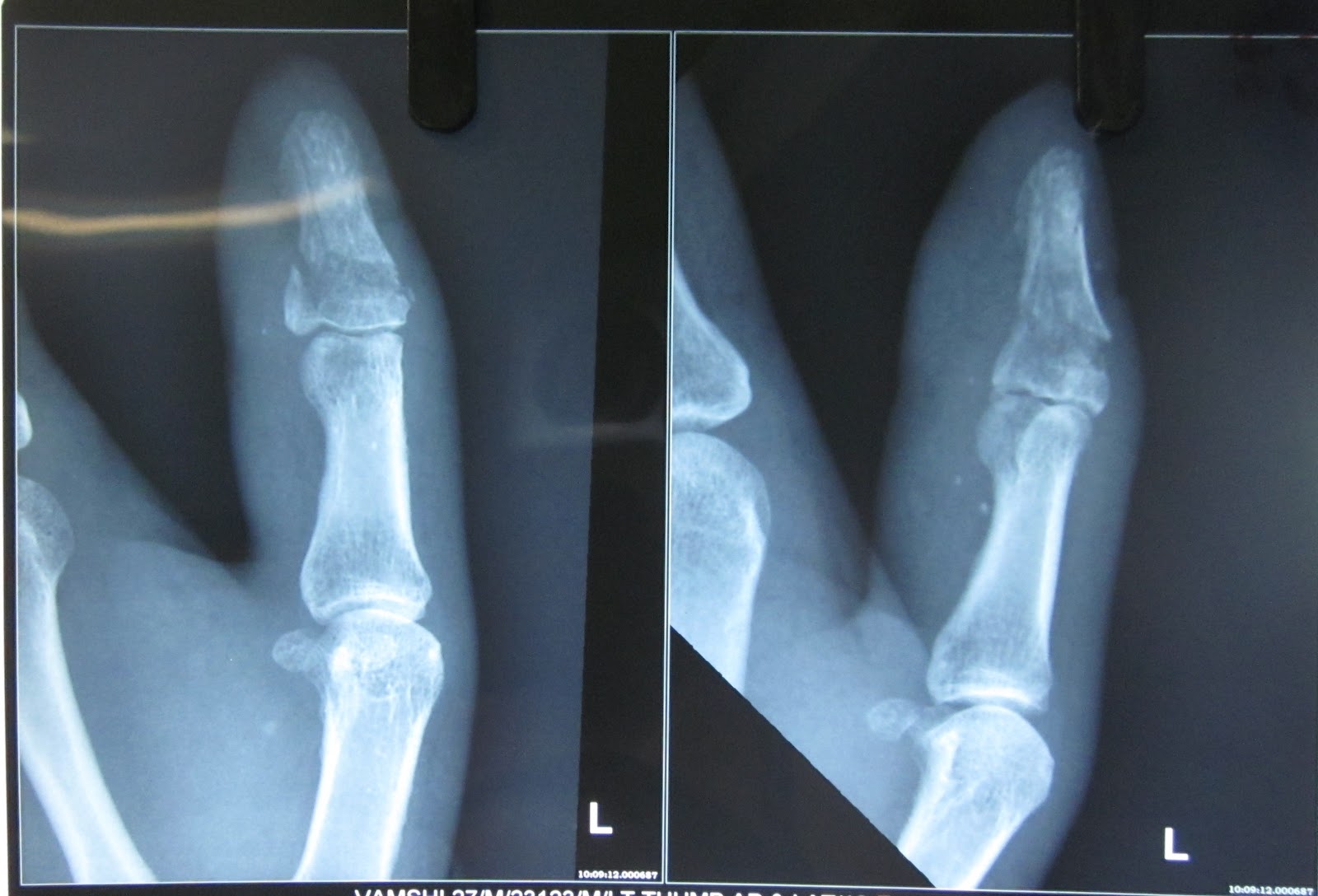 Трещина фаланги. Перелом ногтевой фаланги рентген. Краевой перелом ногтевой фаланги. Закрытый внутрисуставной краевой перелом ногтевой фаланги 1 пальца. Перелом ногтевой фаланги 1 пальца.