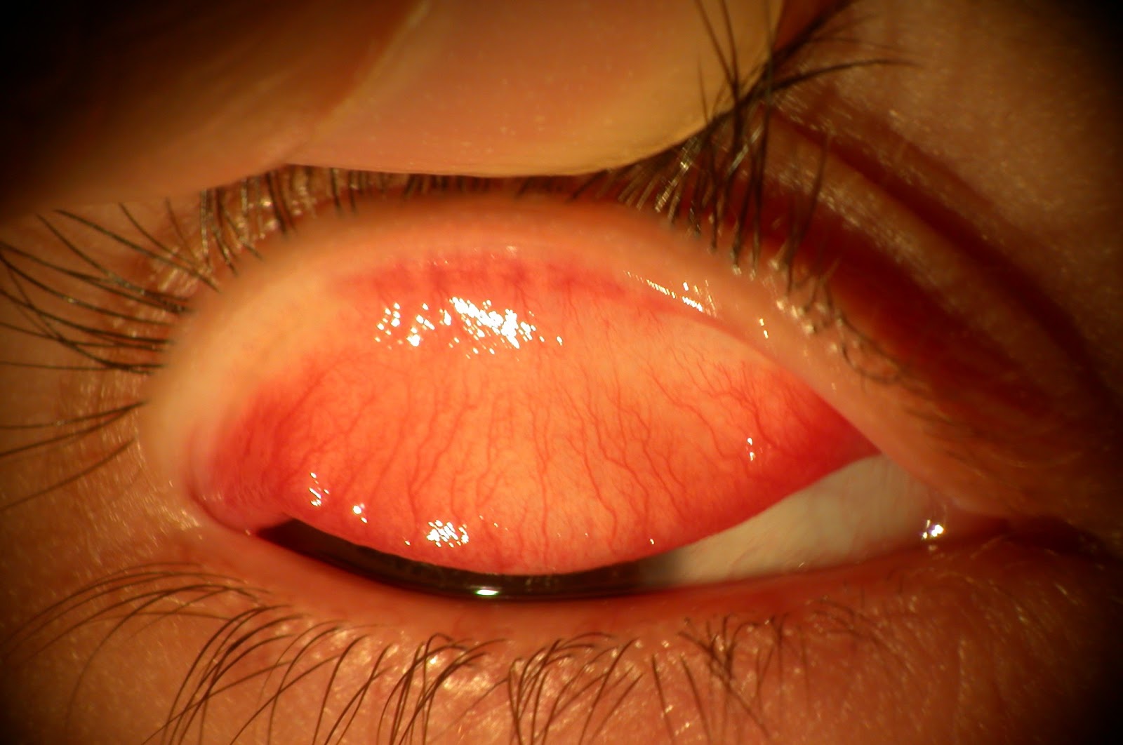 conjunctivitis treatment what is papillary conjunctivitis definition symptoms causes treatment conjunctivitis treatment what is papillary conjunctivitis definition symptoms causes treatment