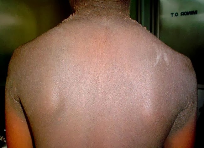 picture of acanthosis nigricans affected back of a child