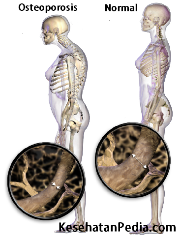 Osteoporosis - Pengeroposan Tulang