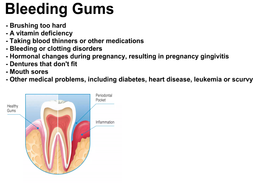 Bleeding gums treatment