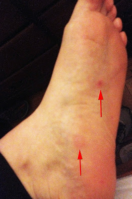 Day 4, larger blisters on left foot