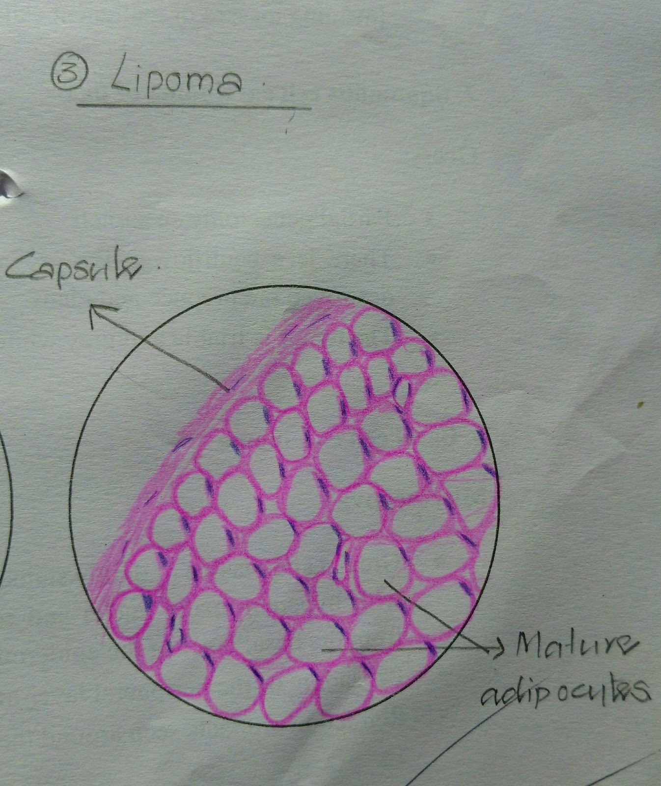 Histopathology Drawings Lipoma