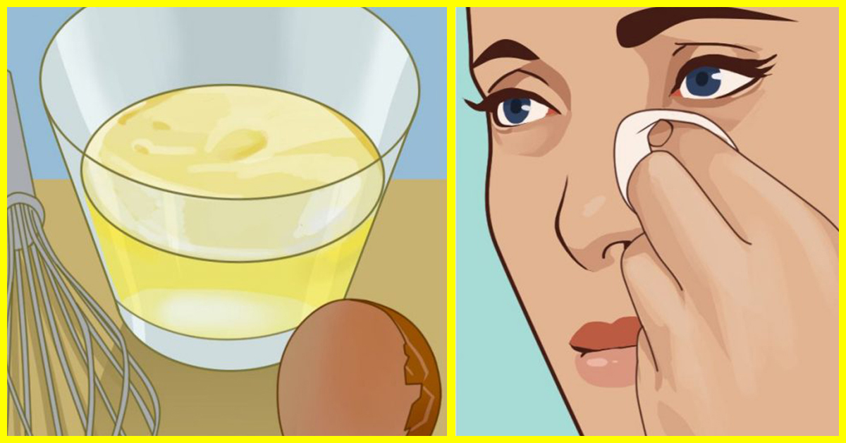 Remove Dark Circles And Under Eye Bags With Baking Soda And Lemon