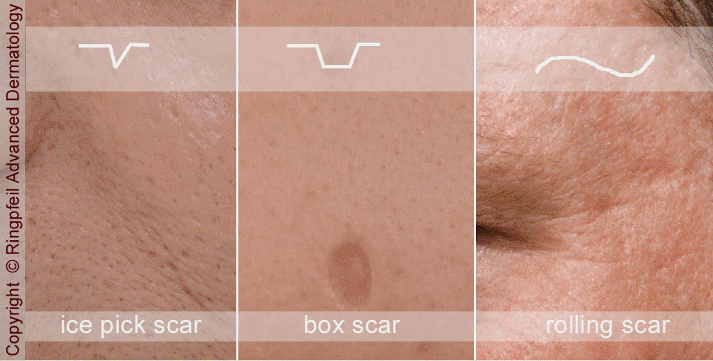 Treating Acne scars in Salt Lake City, Utah Acne Scar Types