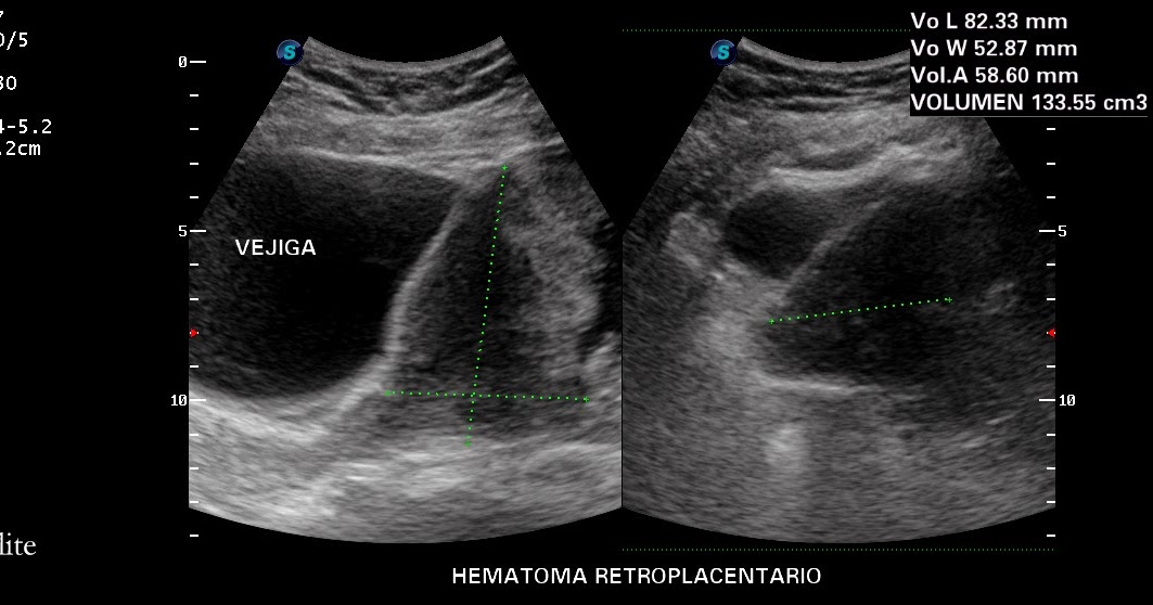 Placenta Previa & Hematoma Retroplacentario