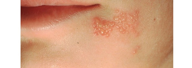 skin rashes that itch and burn