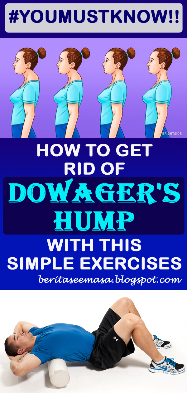 HOW TO GET RID OF DOWAGER'S HUMP WITH THIS SIMPLE EXERCISES world of health