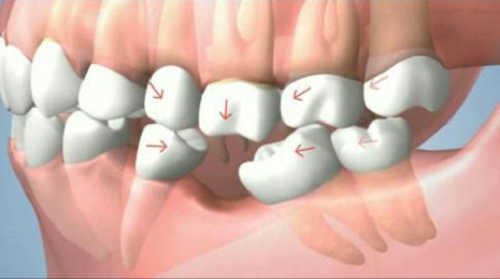 trồng răng cấm bằng phương pháp cấy ghép Implant -
