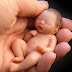 MISCARRIAGES: Symptoms, Causes, Test and Prevention-GregoryHealthworld