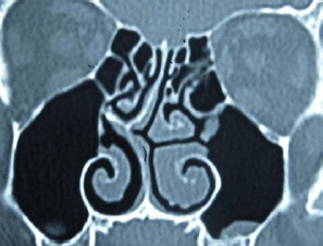 CT-nose-deviated-septum
