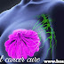 ब्रैस्ट कैंसर के लक्षण, कारण और इलाज, Symptoms of breast cancer in hindi.