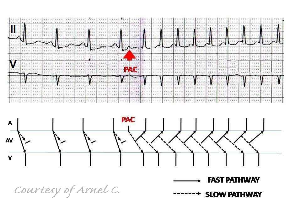 ECG Rhythms Atrial Arrhythmia Triggering AVNRT