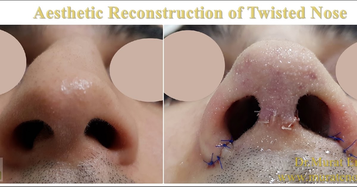 Aesthetic Reconstruction Of Twisted Nose Crooked Nose Deviated Nose