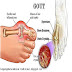 Obat asam urat herbal tradisional murni 100% ampuh Obat asam urat herbal tradisional murni 100% ampuh