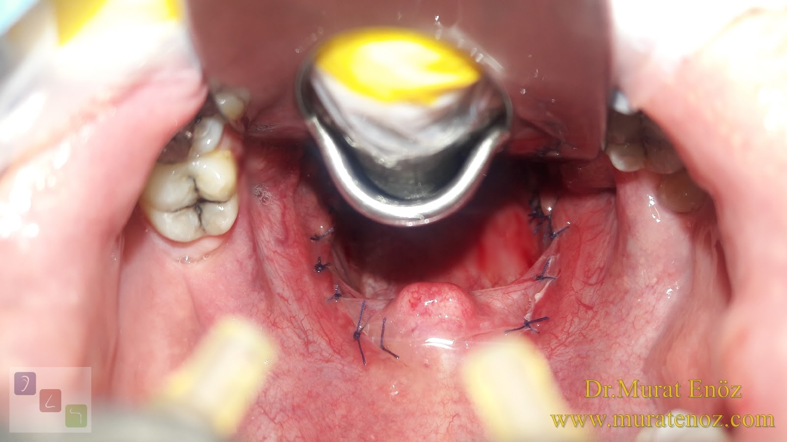 Is Painless and Bloodless Tonsillectomy Operation Possible?