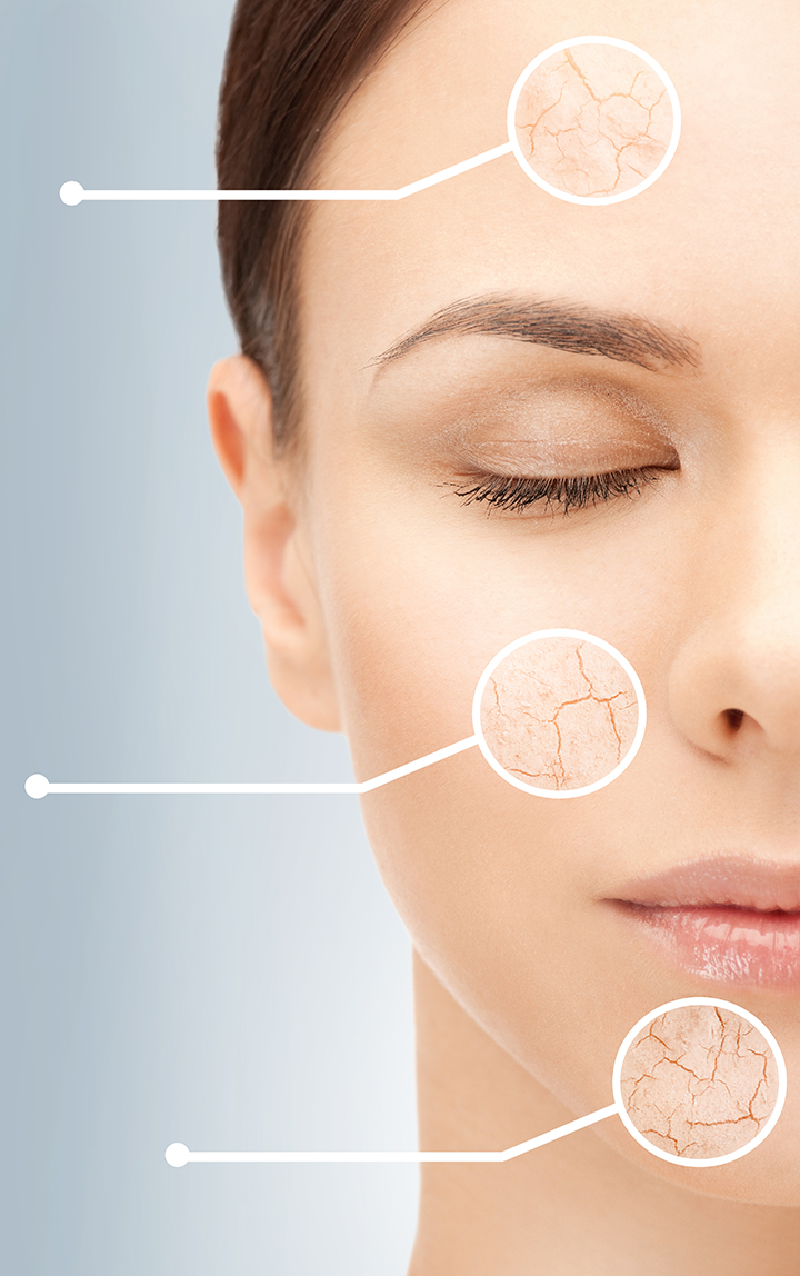 Dry Skin During Winter Right Way To Moisture And Peel dry-skin-during-winter-right-way-to-moisture-and-peel